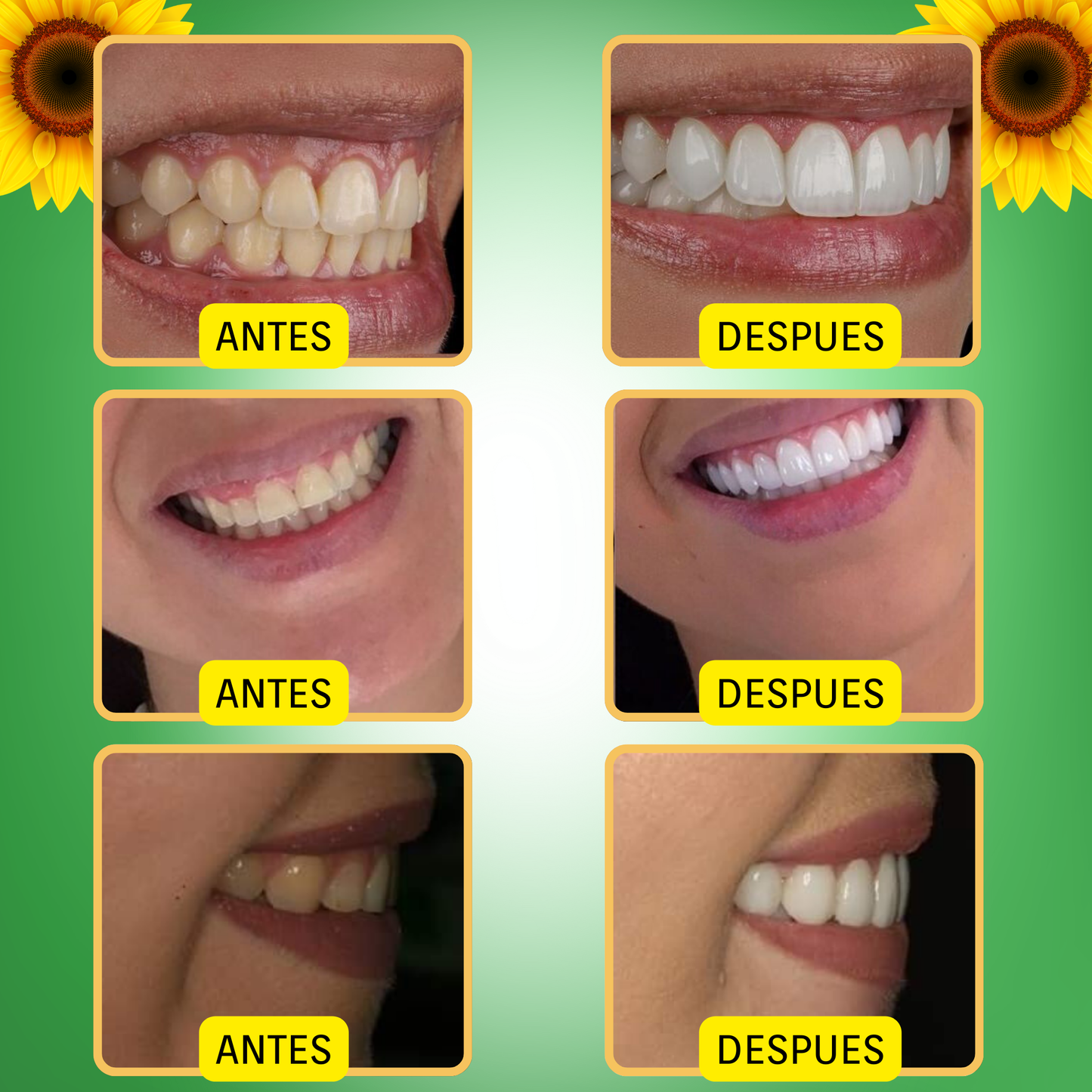 1 + 1 gratis  Dentizen™ - ⛫💨Spray para la regeneración de encías