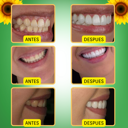 1 + 1 gratis  Dentizen™ - ⛫💨Spray para la regeneración de encías