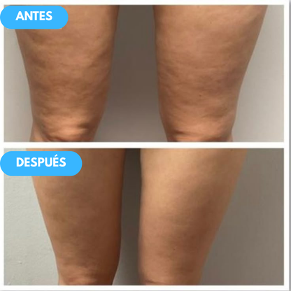 Firmea™ - La forma más rápida de reafirmar tus piernas… sin ejercicio, sin excusas, sin esperar.